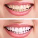 teeth whitening laser zoom enlighten